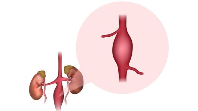 Aneurysm Repair using Endovascular Stent Graft