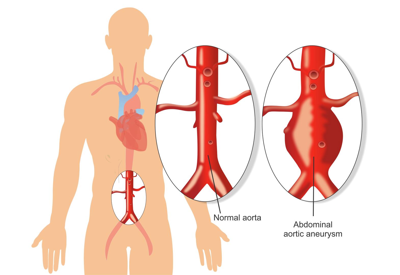 Aortic Aneurysm evaluation and treatment
