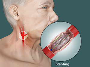 Carotid Artery Disease diagnosis and treatment