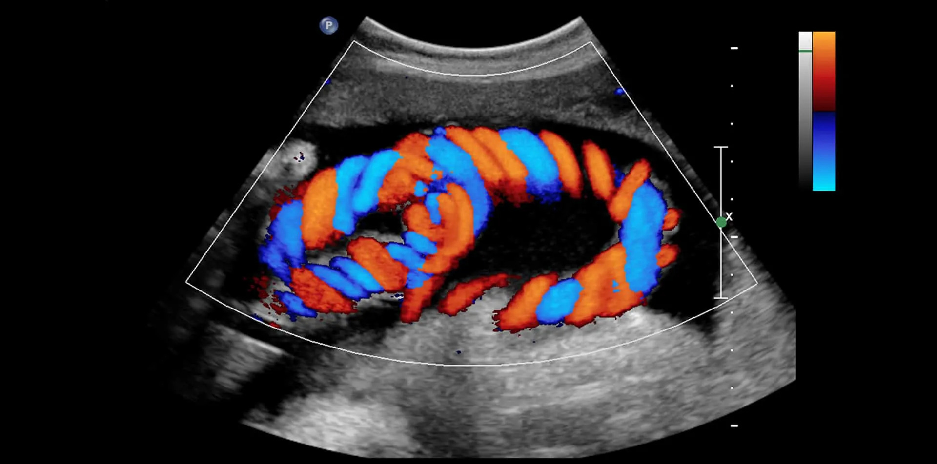 Color Doppler Ultrasound Test