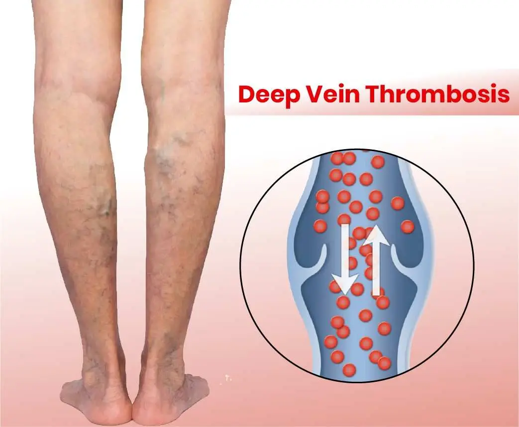 Deep Vein Thrombosis evaluation and treatment
