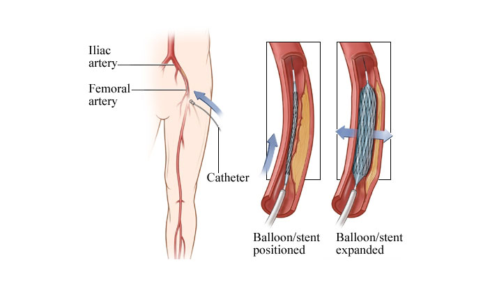 Peripheral Angioplasty Treatment