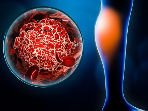 Peripheral Vascular Disease evaluation and treatment
