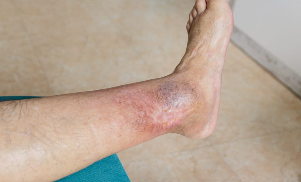 Treatment and management of leg ulcers