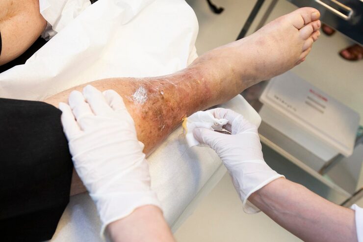 Evaluation and treatment of swollen legs