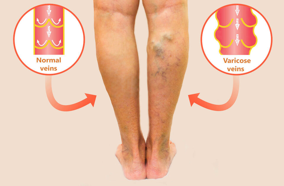 Varicose Veins Treatment