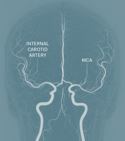 DSA Digital Subtraction Angiography
